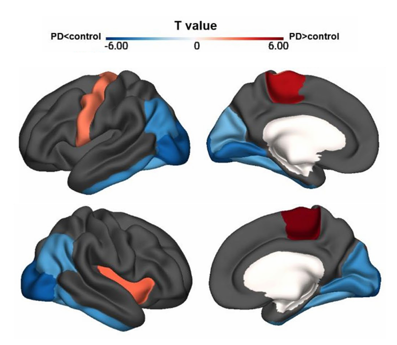 Striatal dopamine transporter uptake predicts neuronal hypometabolism and visuospatial function in Parkinson’s disease