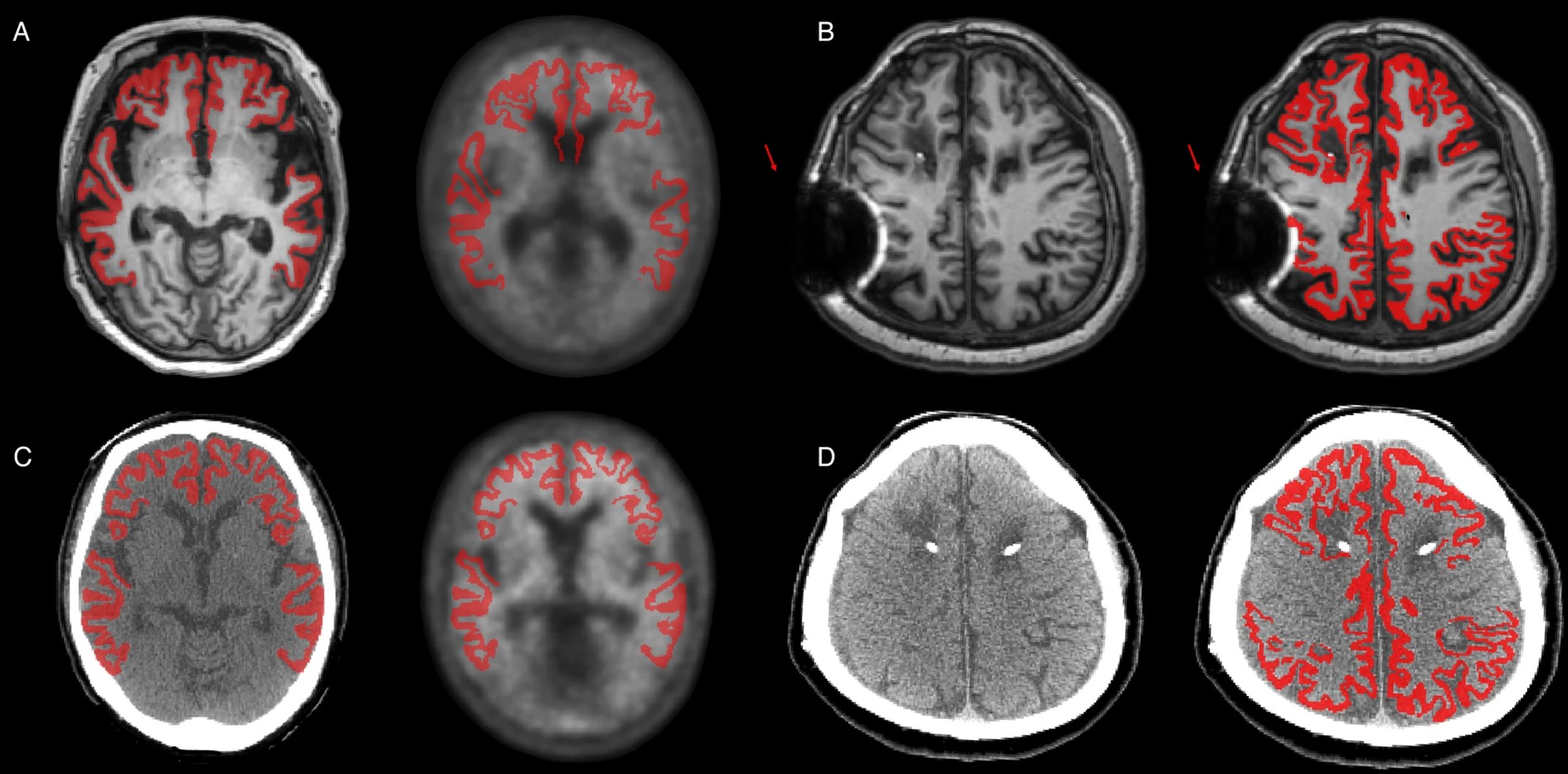 CT parcellation paper thumbnail